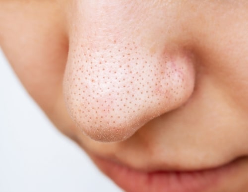 close up of a womans nose showing blackheads